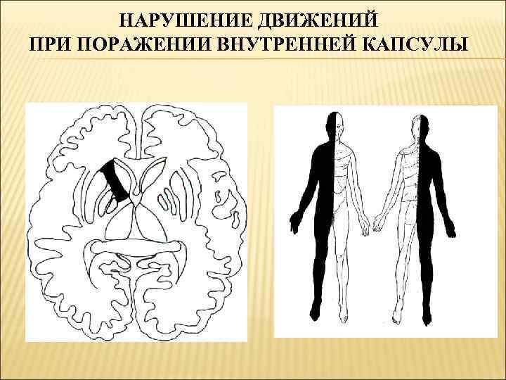   НАРУШЕНИЕ ДВИЖЕНИЙ ПРИ ПОРАЖЕНИИ ВНУТРЕННЕЙ КАПСУЛЫ 