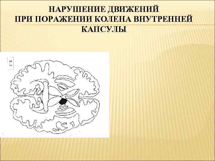 Нарушение движения. Синдром поражения внутренней капсулы. Синдром поражения внутренней капсулы неврология. При поражении внутренней капсулы. При поражении колена внутренней капсулы.