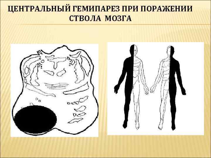 ЦЕНТРАЛЬНЫЙ ГЕМИПАРЕЗ ПРИ ПОРАЖЕНИИ  СТВОЛА МОЗГА 