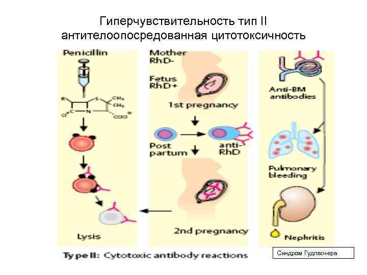  Гиперчувствительность тип II антителоопосредованная цитотоксичность       Синдром Гудпасчера