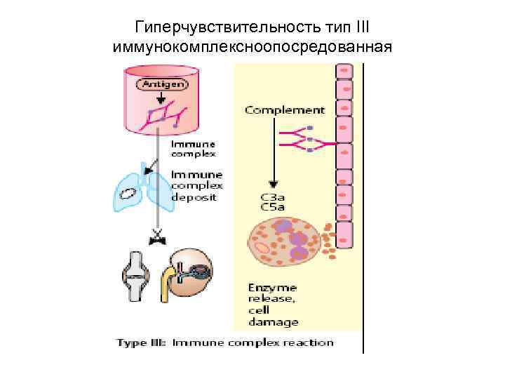  Гиперчувствительность тип III иммунокомплексноопосредованная 