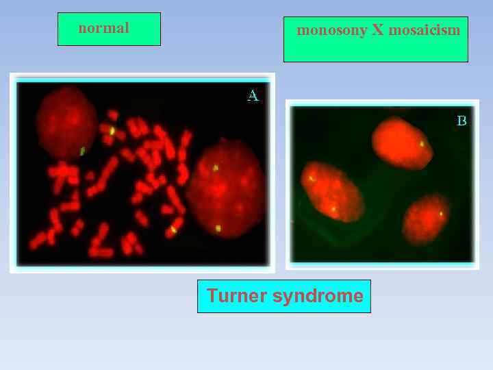 normal  monosony Х mosaicism   Turner syndrome 