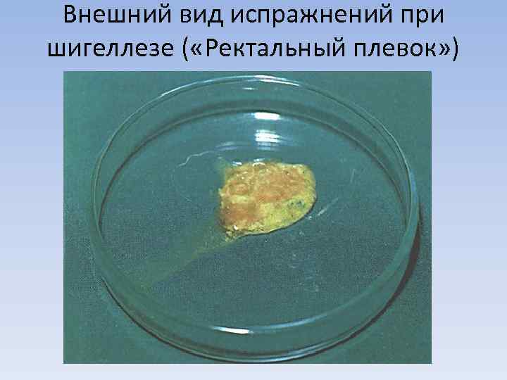  Внешний вид испражнений при шигеллезе ( «Ректальный плевок» ) 