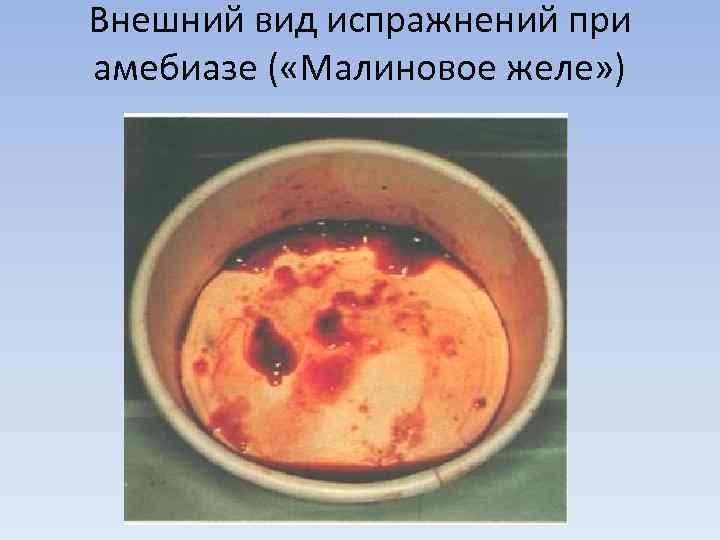 Внешний вид испражнений при амебиазе ( «Малиновое желе» ) 