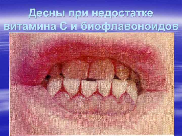 Десны при недостатке витамина С и биофлавоноидов Десны при недостатке витамина С и биофлавоноидов