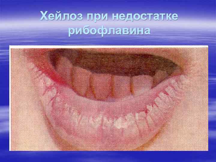 Хейлоз при недостатке рибофлавина Хейлоз при недостатке рибофлавина