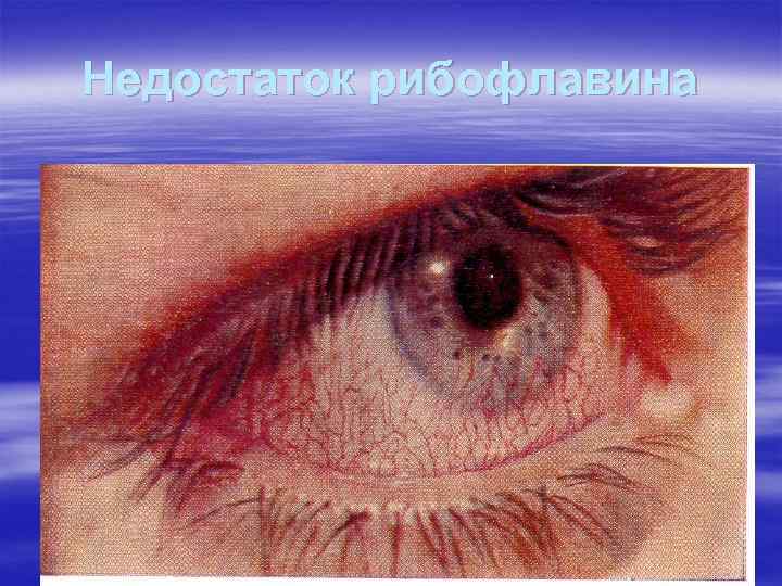 Недостаток рибофлавина Недостаток рибофлавина
