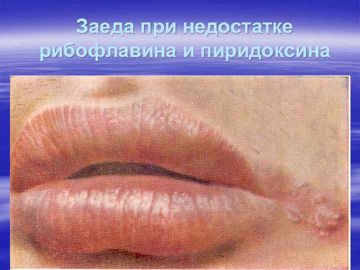 Заеда при недостатке рибофлавина и пиридоксина Заеда при недостатке рибофлавина и пиридоксина
