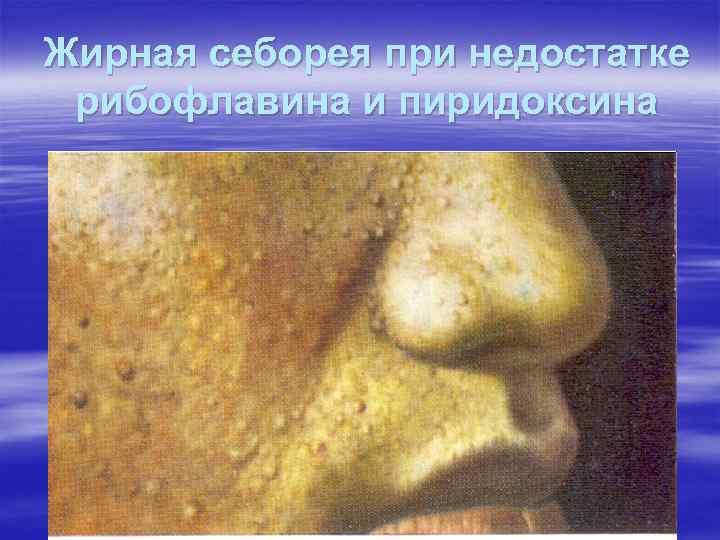 Жирная себорея при недостатке рибофлавина и пиридоксина Жирная себорея при недостатке рибофлавина и пиридоксина