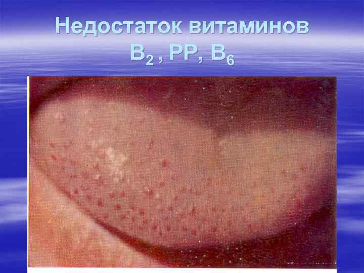 Недостаток витаминов В 2 , РР, В 6 Недостаток витаминов В 2 , РР, В 6