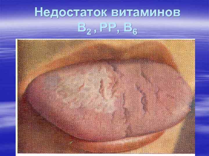 Недостаток витаминов В 2 , РР, В 6 Недостаток витаминов В 2 , РР, В 6