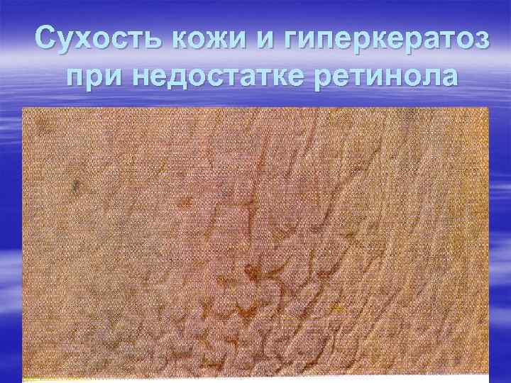 Сухость кожи и гиперкератоз при недостатке ретинола Сухость кожи и гиперкератоз при недостатке ретинола