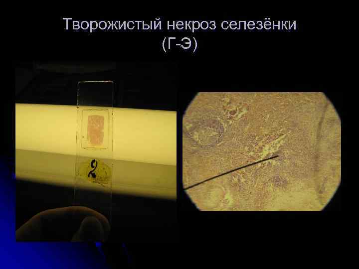 Творожистый некроз селезёнки  (Г-Э) 