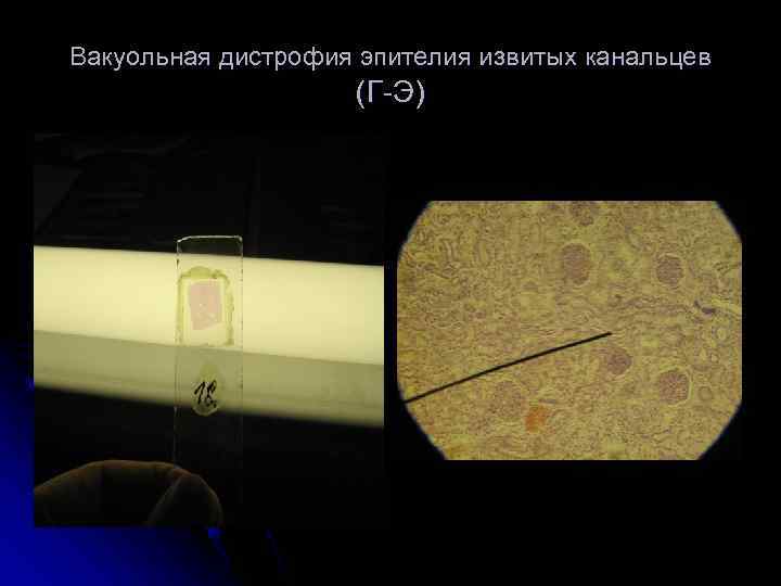 Вакуольная дистрофия эпителия извитых канальцев     (Г-Э) 