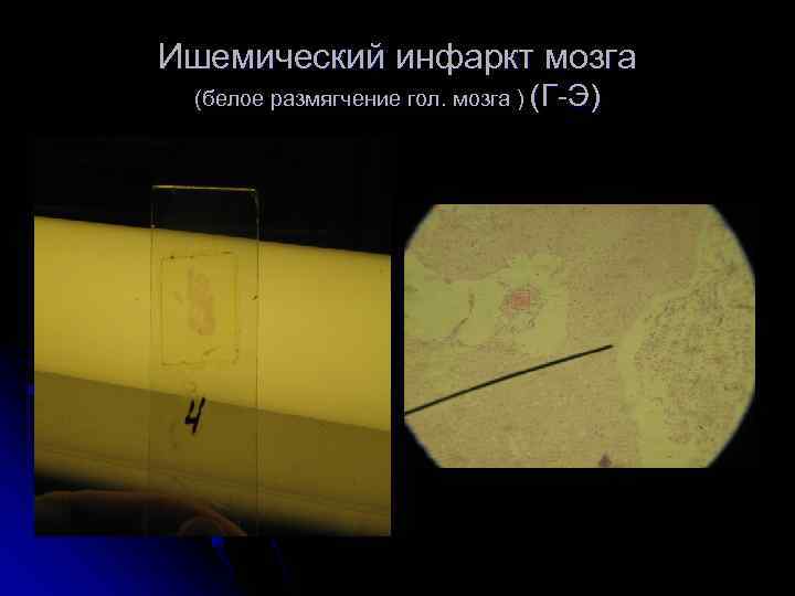 Ишемический инфаркт мозга (белое размягчение гол. мозга ) (Г-Э) 