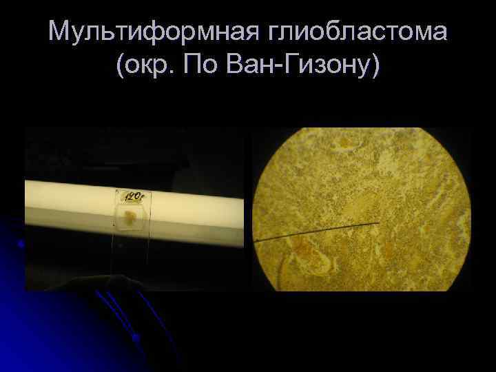 Мультиформная глиобластома (окр. По Ван-Гизону) 