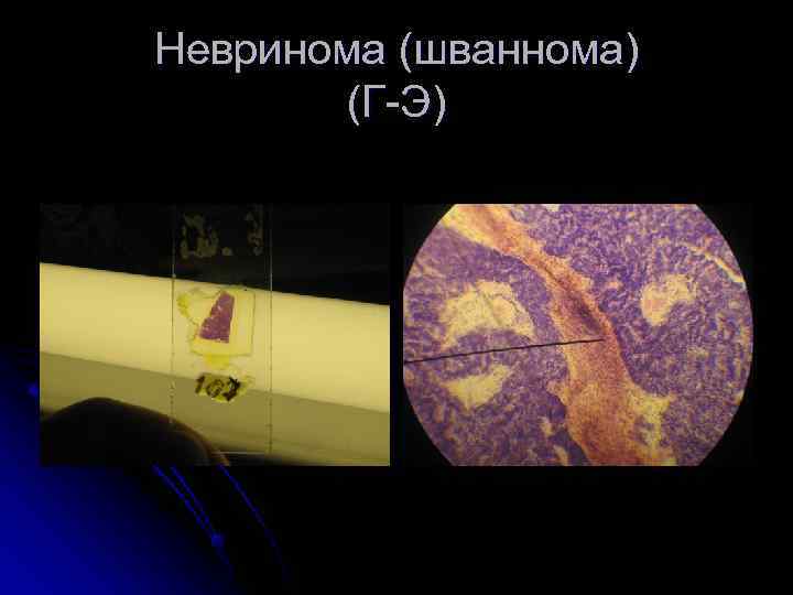 Невринома (шваннома)   (Г-Э) 