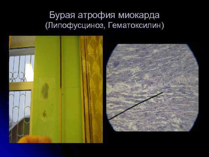 Бурая атрофия миокарда (Липофусциноз, Гематоксилин) 
