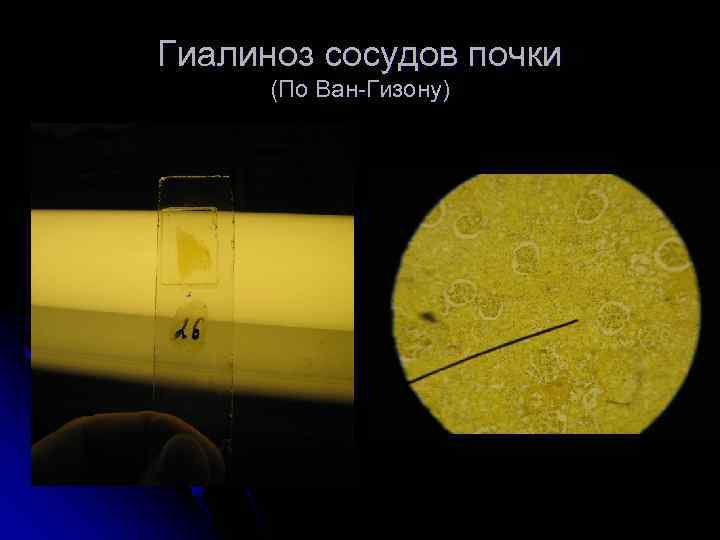 Гиалиноз сосудов почки  (По Ван-Гизону) 