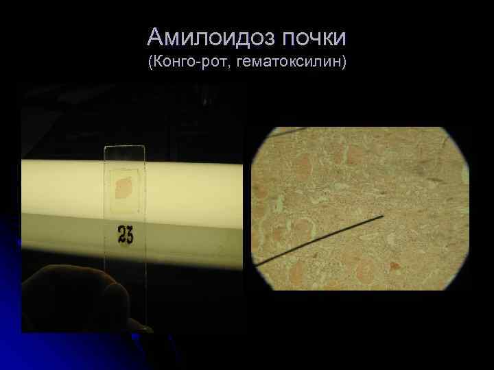 Амилоидоз почки (Конго-рот, гематоксилин) 