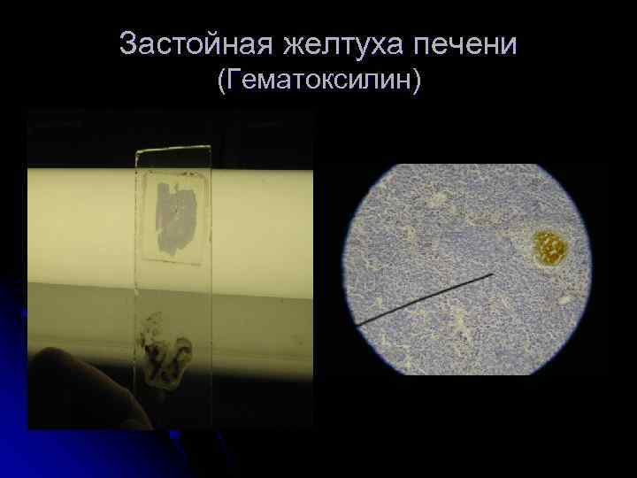 Застойная желтуха печени (Гематоксилин) 