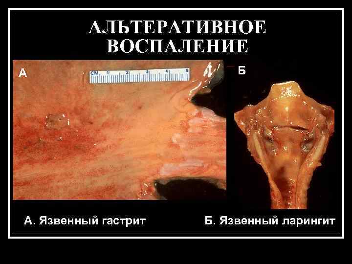    АЛЬТЕРАТИВНОЕ  ВОСПАЛЕНИЕ А     Б А. Язвенный