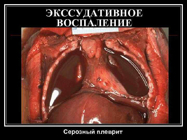 ЭКССУДАТИВНОЕ ВОСПАЛЕНИЕ  Серозный плеврит 