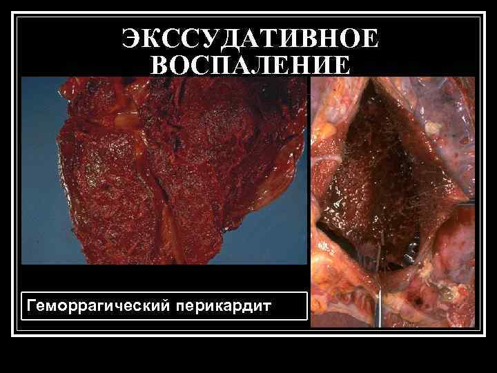    ЭКССУДАТИВНОЕ  ВОСПАЛЕНИЕ Геморрагический перикардит 