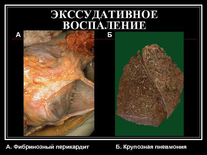    ЭКССУДАТИВНОЕ    ВОСПАЛЕНИЕ  А    