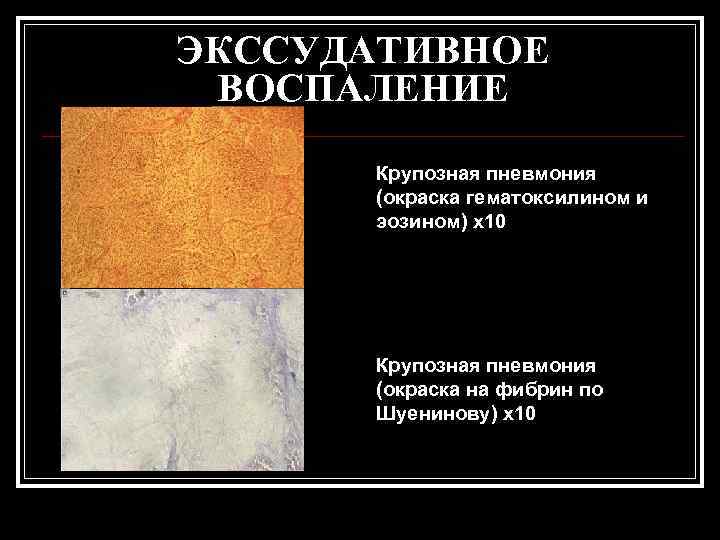 ЭКССУДАТИВНОЕ ВОСПАЛЕНИЕ  Крупозная пневмония  (окраска гематоксилином и  эозином) х10  Крупозная