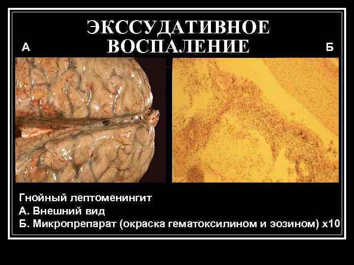   ЭКССУДАТИВНОЕ А  ВОСПАЛЕНИЕ     Б Гнойный лептоменингит А.