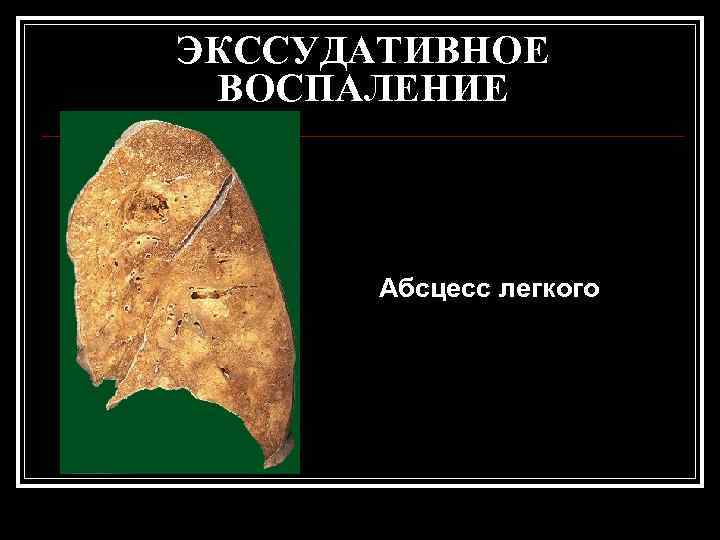 ЭКССУДАТИВНОЕ ВОСПАЛЕНИЕ  Абсцесс легкого 