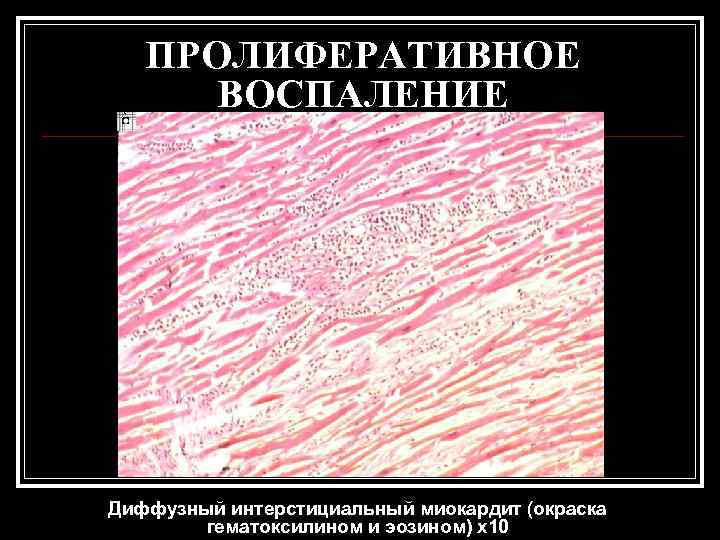   ПРОЛИФЕРАТИВНОЕ  ВОСПАЛЕНИЕ Диффузный интерстициальный миокардит (окраска   гематоксилином и эозином)