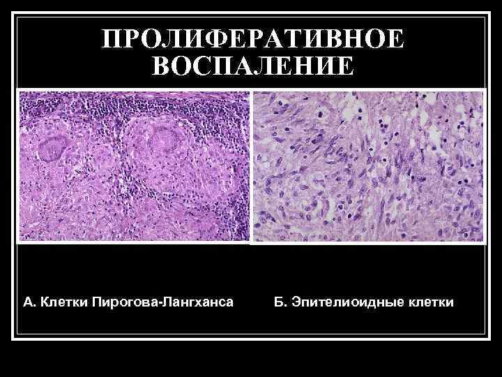 Клетки воспаления. Пролиферативное воспаление патанатомия. Пролиферативное (продуктивное) воспаление. Пролетеравианое воспаления. Диффузное продуктивное воспаление.