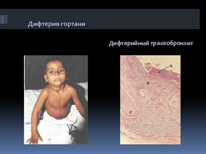Дифтерия гортани     Дифтерийный трахеобронхит 