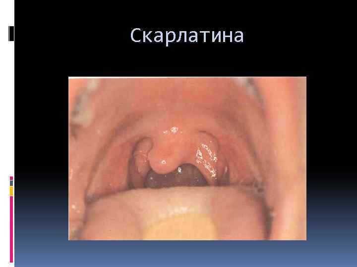 Скарлатина 