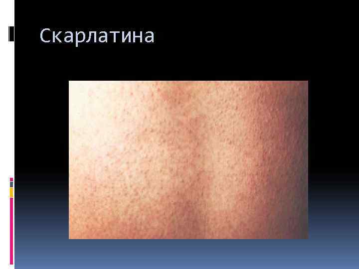 Скарлатина 