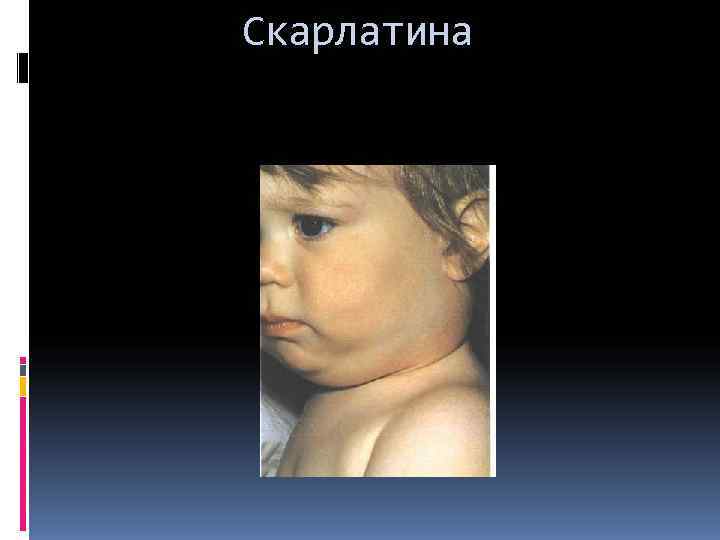 Скарлатина 