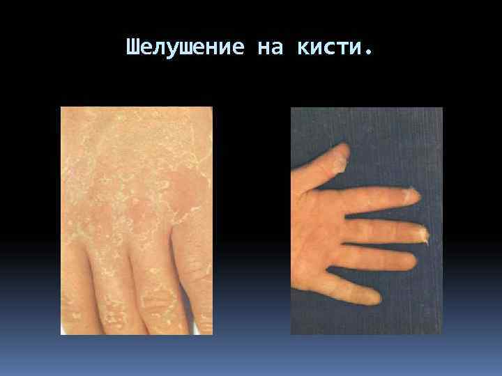Шелушение на кисти. 