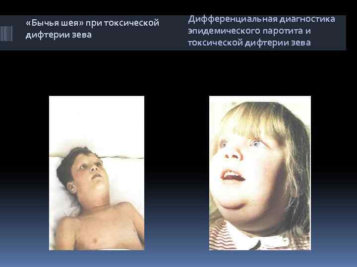  «Бычья шея» при токсической  Дифференциальная диагностика дифтерии зева   эпидемического паротита
