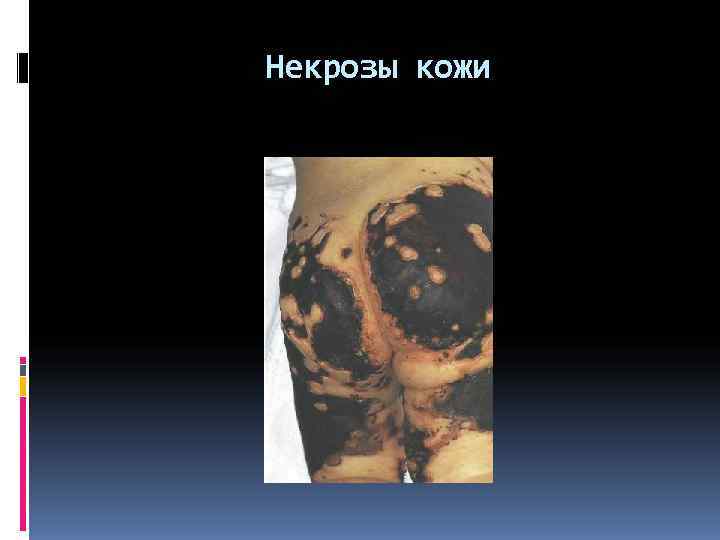 Некрозы кожи 