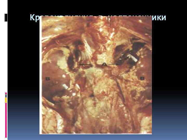 Кровоизлияния в надпочечники 