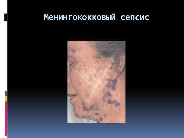 Менингококковый сепсис 