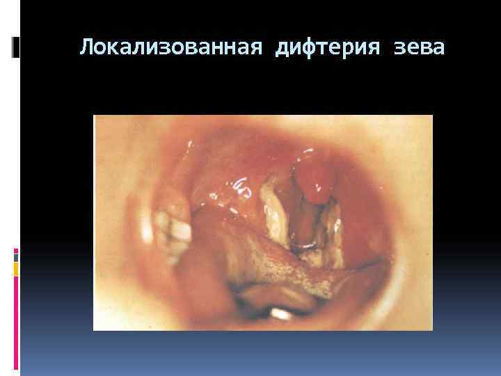 Локализованная дифтерия зева 