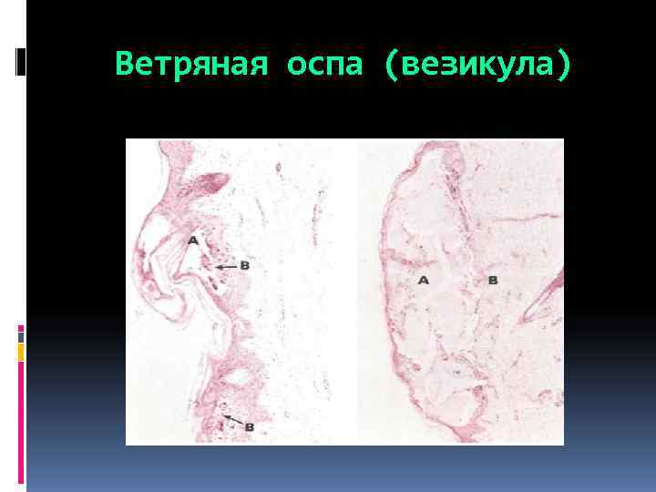 Ветряная оспа (везикула) 