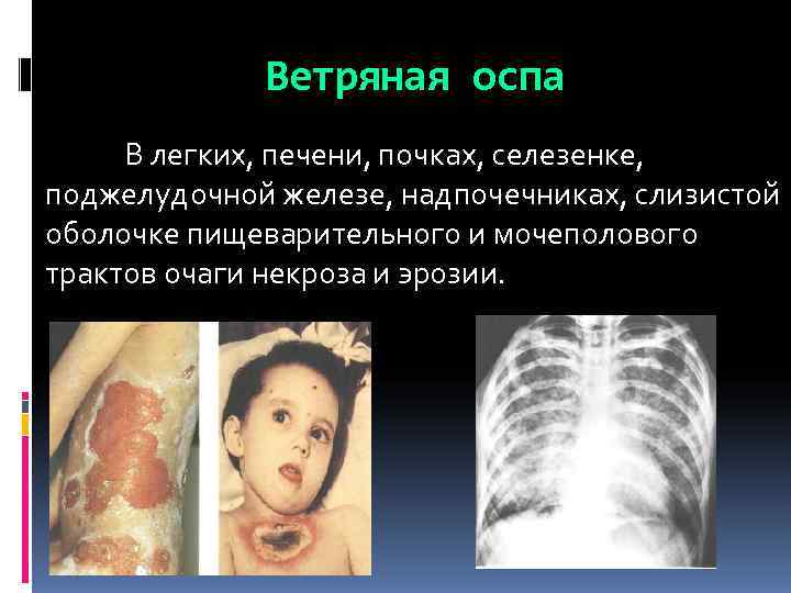    Ветряная оспа В легких, печени, почках, селезенке, поджелудочной железе, надпочечниках, слизистой