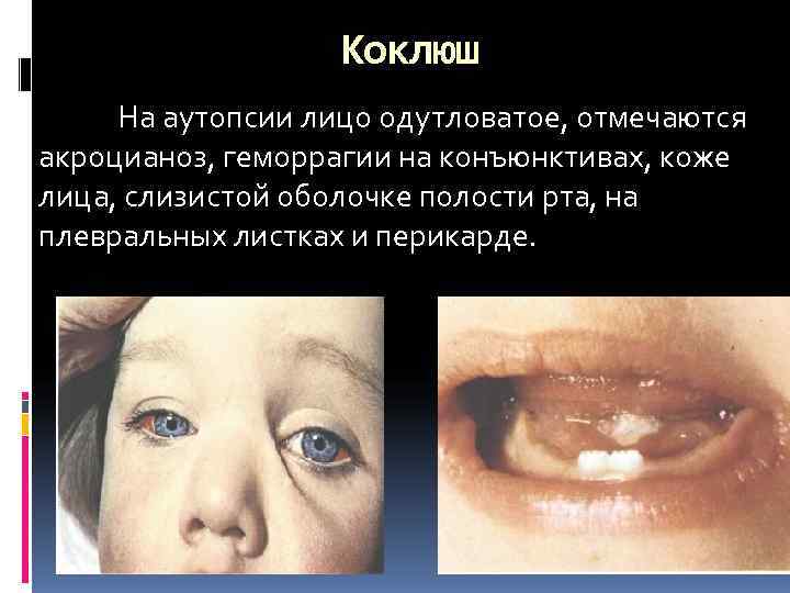     Коклюш На аутопсии лицо одутловатое, отмечаются акроцианоз, геморрагии на конъюнктивах,