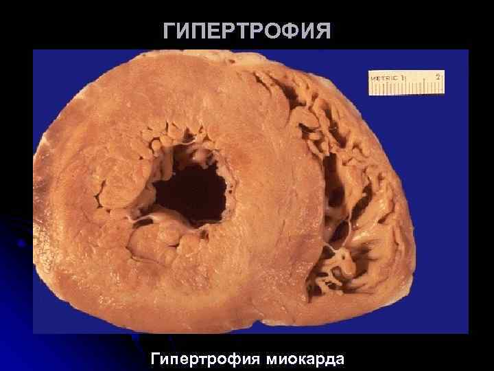 ГИПЕРТРОФИЯ Гипертрофия миокарда ГИПЕРТРОФИЯ Гипертрофия миокарда