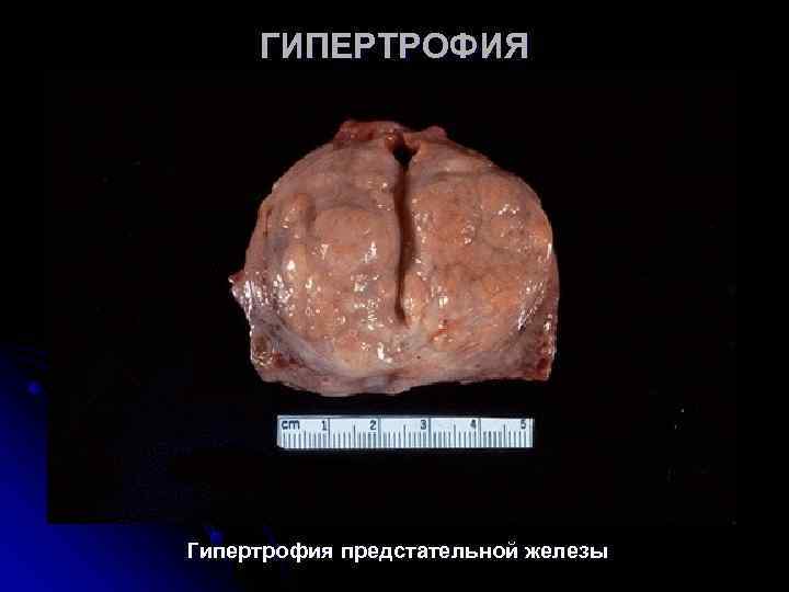 ГИПЕРТРОФИЯ Гипертрофия предстательной железы ГИПЕРТРОФИЯ Гипертрофия предстательной железы