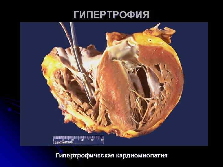 ГИПЕРТРОФИЯ Гипертрофическая кардиомиопатия ГИПЕРТРОФИЯ Гипертрофическая кардиомиопатия